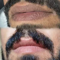 رفع دائمی تیرگی لب