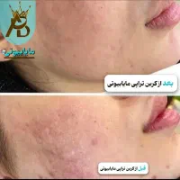 کربن تراپی،روشن کنندگی نواحی بدن صورت،منافذ باز،لک