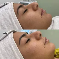 پاکسازی و جوانسازی صورت
