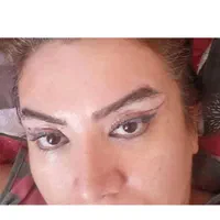 جراحی عمل پلک/بلفاروپلاستی/تزریق چربی/ساکشن غبغب