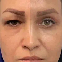کرم۱۴کاربیوممتیک ضدچروک وضدلک درمان افتادگی پلک