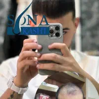 فقط برای ۱ نفر، کاشت مو با ۷۰٪ تخفیف ۱۵ میلیون
