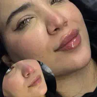 کلینیک فیلر  ۹۹۹و بوتاکس کل صورت ۹۹۸