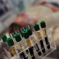 انجام تخصصی پی ار پی (prf) مزوتراپی.مرکزprp