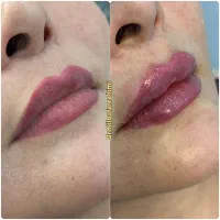 آمپول لاغری-ژل-بوتاکس-فیلربادی-پی ار پی توسط پزشک