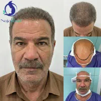 نژا کاشت مجموعه تخصصی کاشت مو و ابرو از سال 1383