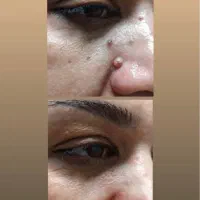 خال‌برداری تخصصی داخل مطب،،قیمت مناسب، نتیجه فوری