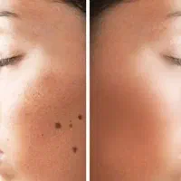 جراحی خال میخچه ضایعات پوستی تخصصی
