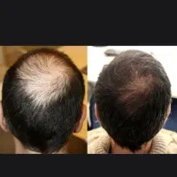 خداحافظی با ریزش و کم پشتی مو