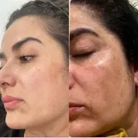 «دکتر کامبیز محمدپور»آفر50%لیزری،سفیدکردن صورت بدن
