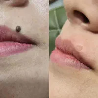 خال برداری-برداشتن خال،نشانه،منگلوله گوشتی
