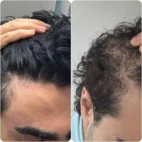 با نانو تو ۳۰ روز موهات برگردون
