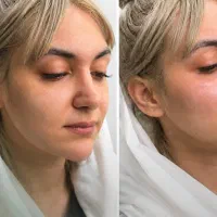 تخفیف ویژه بوتاکس،ژل لب‌،لیفت صورت بانخ توسط پزشک
