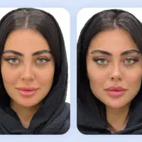 زاویه سازی فک و گونه ، کانتورینگ صورت