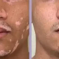 پماد ویتیلیگو لک وپیس