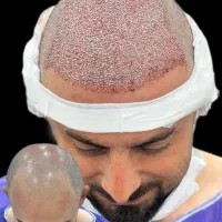 بزرگترین مرکز کاشت مو گیلان(اقساطی)