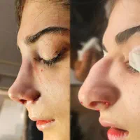 آف جراحی بینی ۲۰ت ولیپوساکشن وابدودراهواز