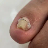 درمان ناخن فرورفته در گوشت