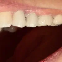 روکش تمام سرامیک و‌فلز سرامیک با قیمت قبلی