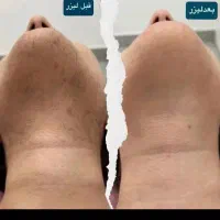 لیزربدن،کربن ،پی آرپی،بوتاکس