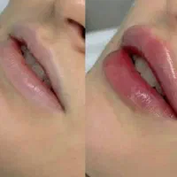 نیازمند مدل تزریق لب