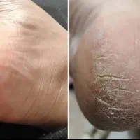 کرم ترک پا