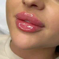 تخفیف ویژه ژل بوتاکس700،آموزش ژل بوتاکس مزو10 تومن