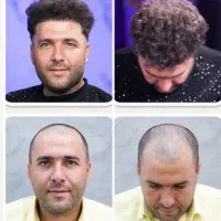 کاشت مو تضمینی با اقساط