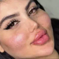 ژل بوتاکس در کلینیک زیبایی(تخفیف ویژه)