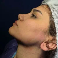 ساکشن غبغب بوکالفت بلفاروپلاستی و تزریق چربی|خدمات زیبایی و سلامت|تهران, صادقیه|دیوار