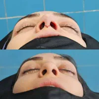 تخفیف عمل بینی