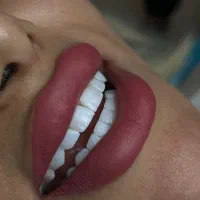 کامپوزیت فکی ۴/۵۰۰ به مدت یک هفته