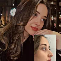 جشنواره طلایی عمل بینی با قیمت نصف شهرستان