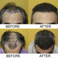 تکنسین کاشت مو (پانچ زن برداشت مو)