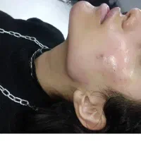 تزریق فیلر فول فیس  تخصصی بایوفیلر، بوتاکس