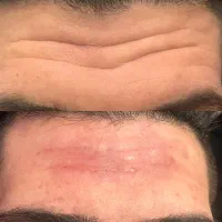 تزریق فیلر و بوتاکس