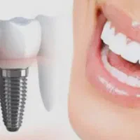 ایمپلنت کره یکروزه دیجیتال۱۵۶۰۰ با روکش رایگان