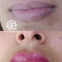 جوانسازی با دستگاه های به روز و فیلرهای مرغوب