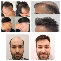 راه حل طبیعی کم پشتی مو /بدون جراحی
