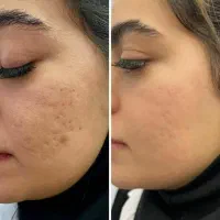کرم های معجزه گربیوممتیک