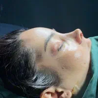 جراحی بینی طبیعی در تهران