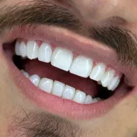 کامپوزیت دندان،کامپوزیت ونیر