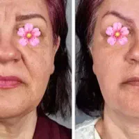 ضد چروک ۱۰ کاره قوی بیوممتیک