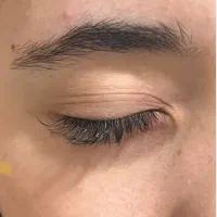 خالبرداری و برداشت زگیل و کک و مک در مطب