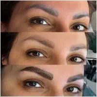 ریموو پاک کردن تتو‌ خالکوبی توسط پزشک خالبرداری