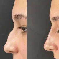 فیلربادی مزوژل فیلر صورت لیفت شقیقه بوتاکس لاغری