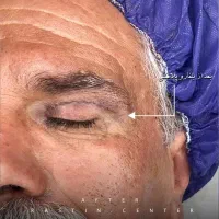 بلفاروپلاستی با قیمت استثنایی