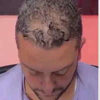 چربی و‌ کمپشتی مو قابل درمانه
