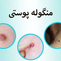 حذف منگوله ی پوستی در یک جلسه