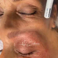 بلفاروپلاستی پلک بدون جراحی (تخفیف ویژه)